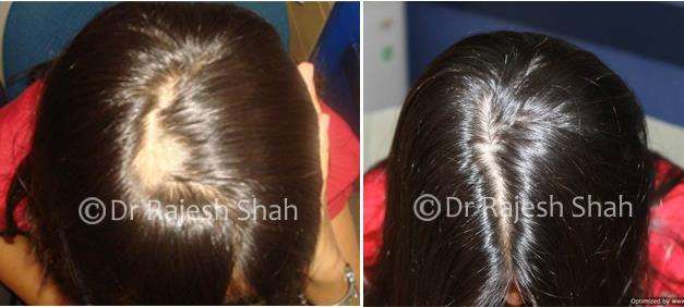 Alopecia Areata Before and After Case Photo