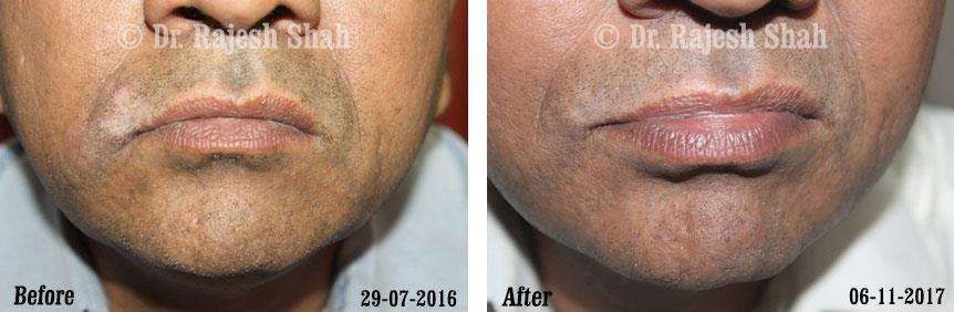 Vitiligo Before and After Case Photo