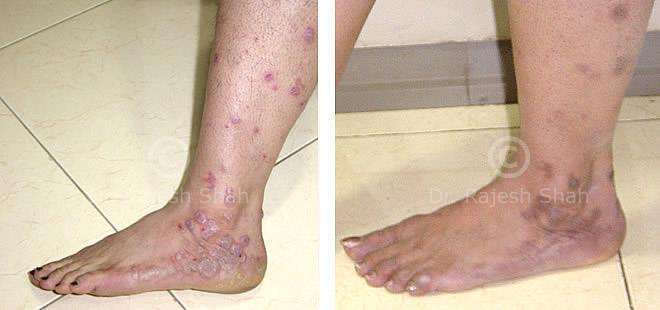 Lichen Planus Before and After Case Photo