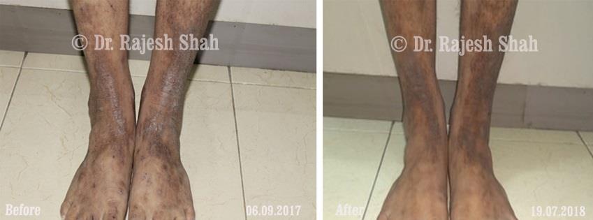 Prurigo Nodularis Before and After Case Photo