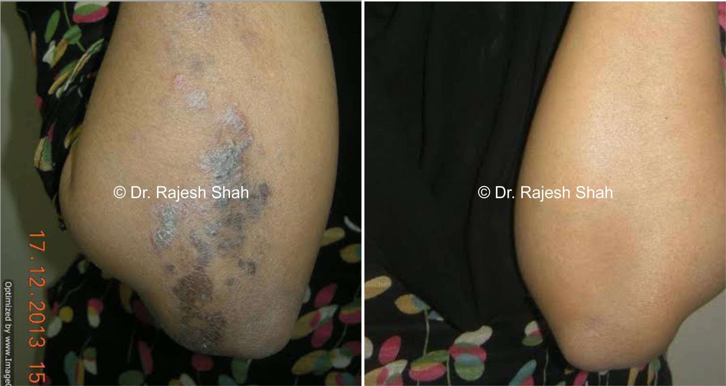 Lichen Planus Before and After Case Photo
