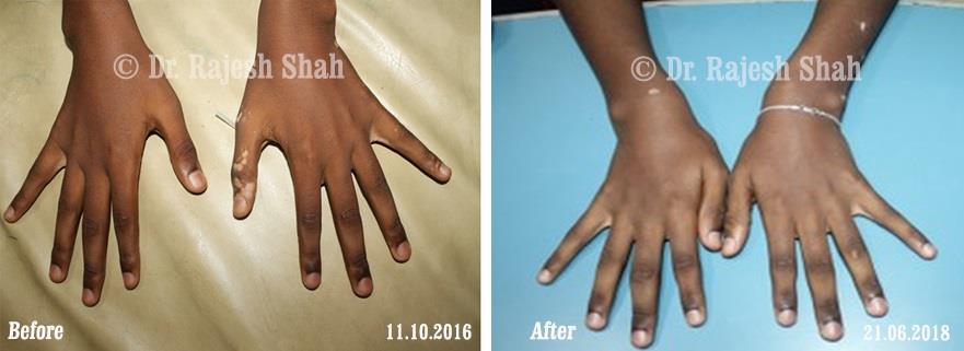 Vitiligo Before and After Case Photo