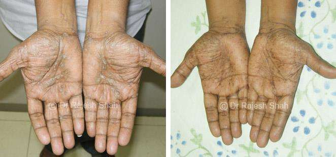 Lichen Planus Before and After Case Photo