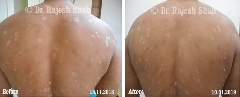 Psoriasis Before and After Case Photo
