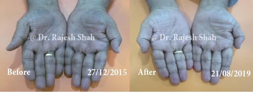 Psoriasis Before and After Case Photo