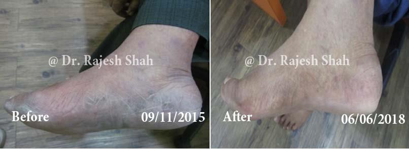 Psoriasis Before and After Case Photo