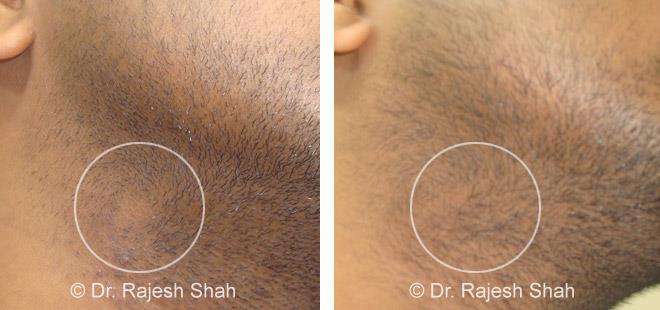 Alopecia Areata Before and After Case Photo