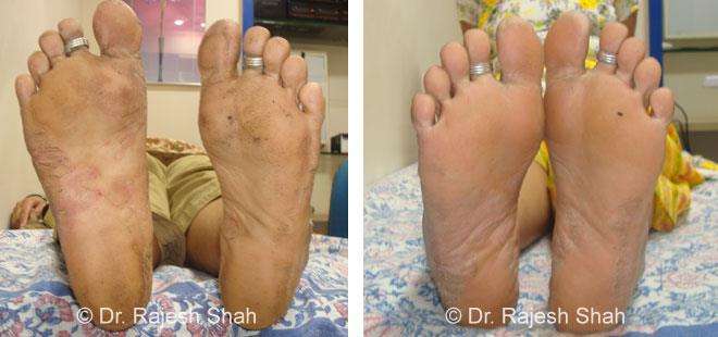 Psoriasis Before and After Case Photo