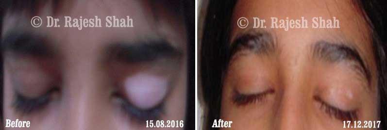 Vitiligo Before and After Case Photo