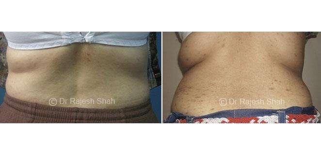 Lichen Planus Before and After Case Photo