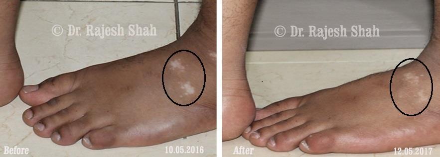 Vitiligo Before and After Case Photo