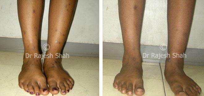 Lichen Planus Before and After Case Photo