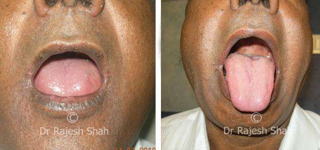 Lichen Planus Before and After Case Photo