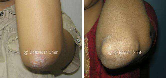 Psoriasis Before and After Case Photo