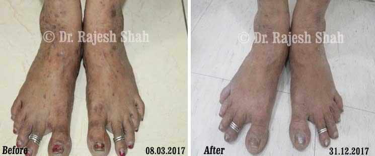 Lichen Planus Before and After Case Photo