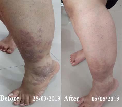 Psoriasis Before and After Case Photo