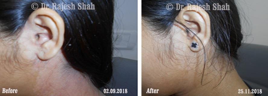 Psoriasis Before and After Case Photo