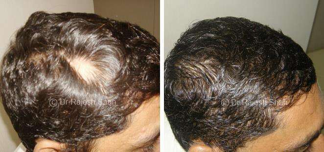 Alopecia Areata Before and After Case Photo