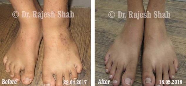 Lichen Planus Before and After Case Photo