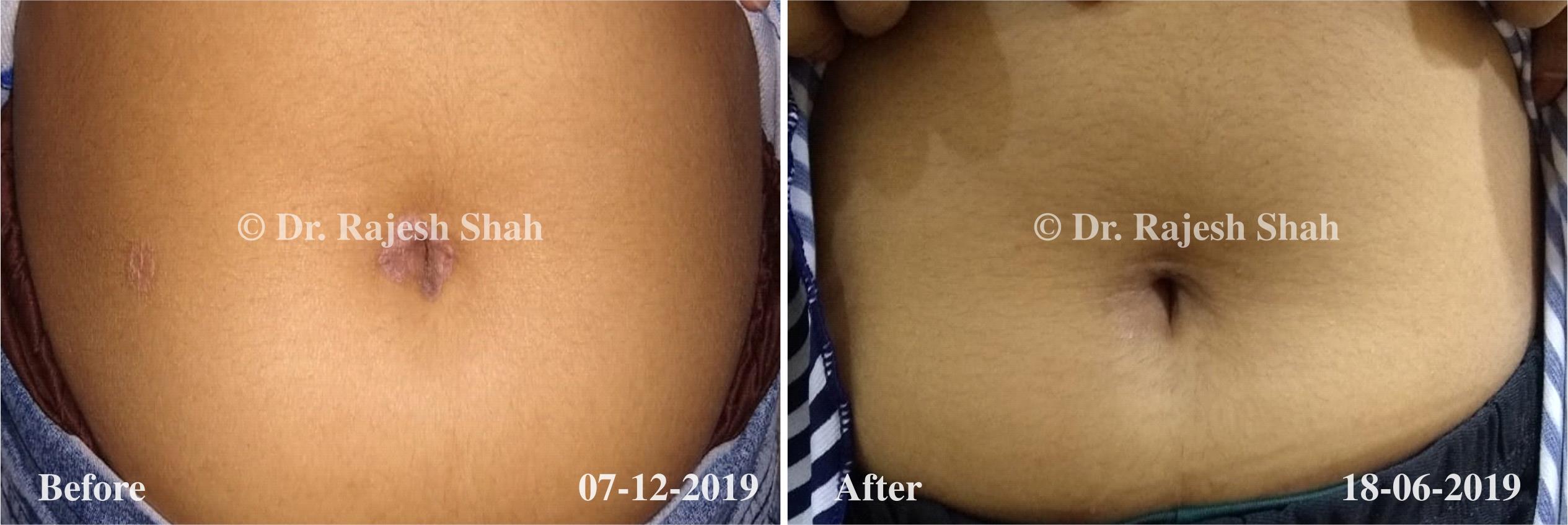 Psoriasis Before and After Case Photo