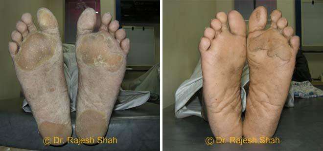 Psoriasis Before and After Case Photo