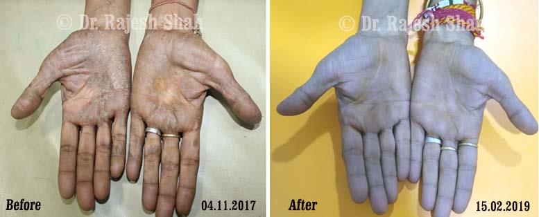 Psoriasis Before and After Case Photo