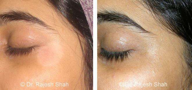 Vitiligo Before and After Case Photo