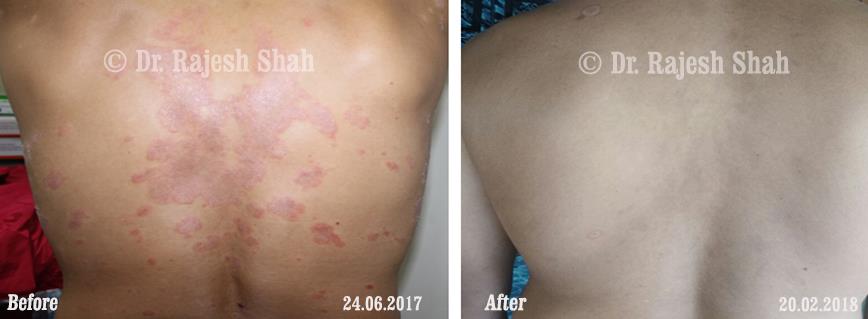Psoriasis Before and After Case Photo