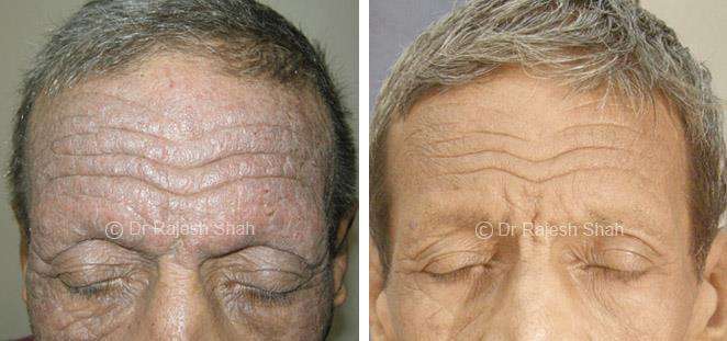 Atopic Dermatitis Before and After Case Photo