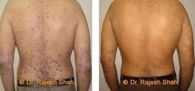 Psoriasis Before and After Case Photo