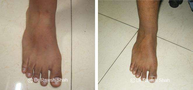 Lichen Planus Before and After Case Photo