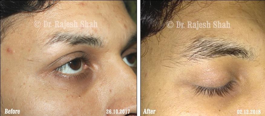 Alopecia Areata Before and After Case Photo