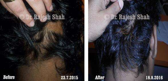 Alopecia Areata Before and After Case Photo