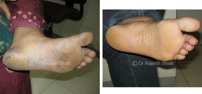 Psoriasis Before and After Case Photo