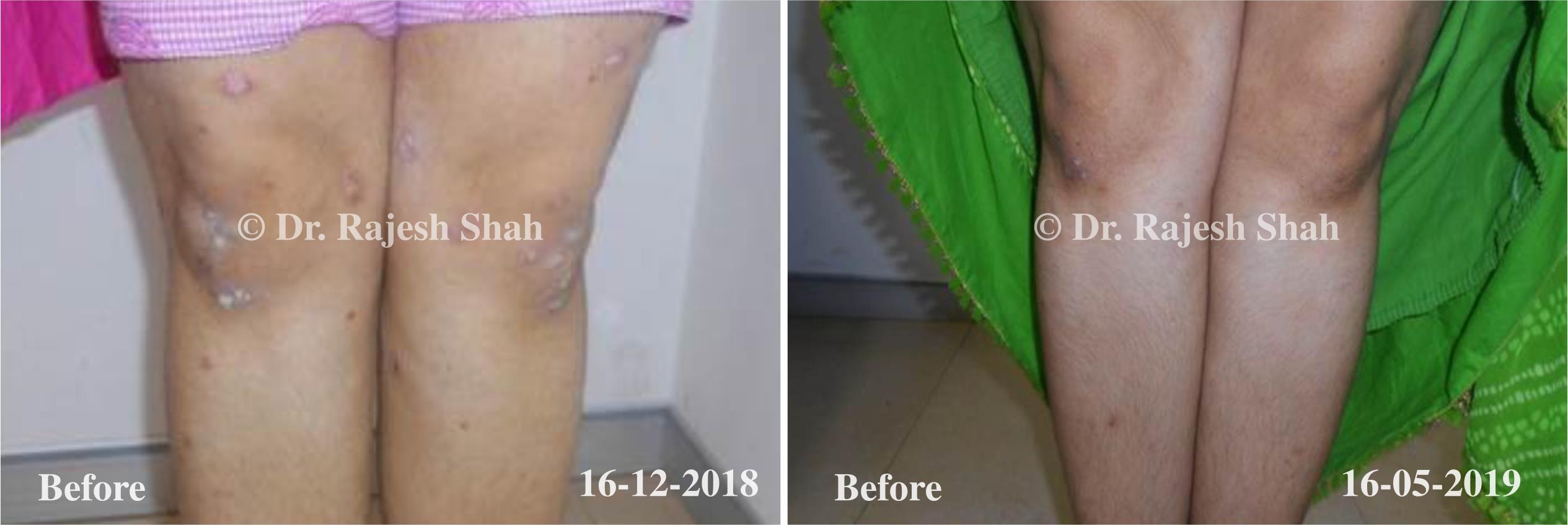 Psoriasis Before and After Case Photo