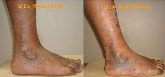 Lichen Planus Before and After Case Photo