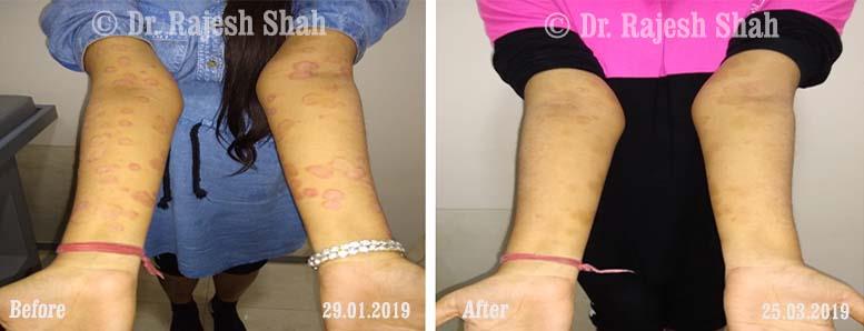 Psoriasis Before and After Case Photo