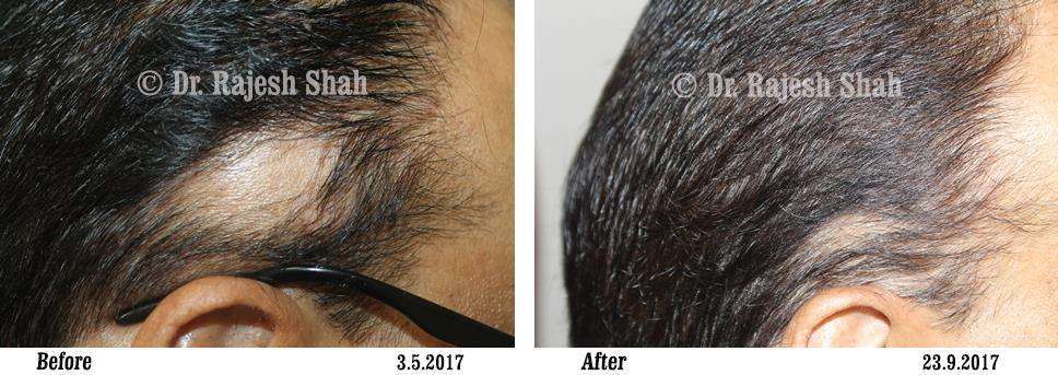 Alopecia Areata Before and After Case Photo