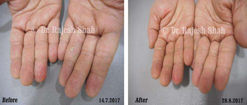 Atopic Dermatitis Before and After Case Photo