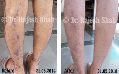 Lichen Planus Before and After Case Photo