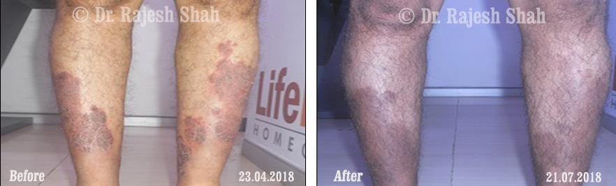 Psoriasis Before and After Case Photo