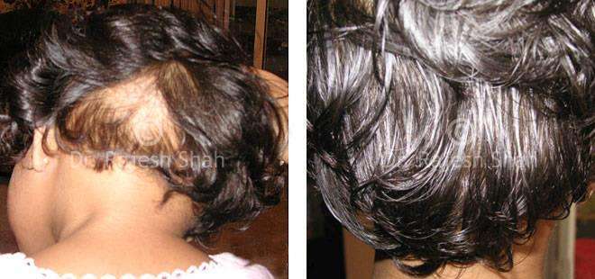 Alopecia Areata Before and After Case Photo