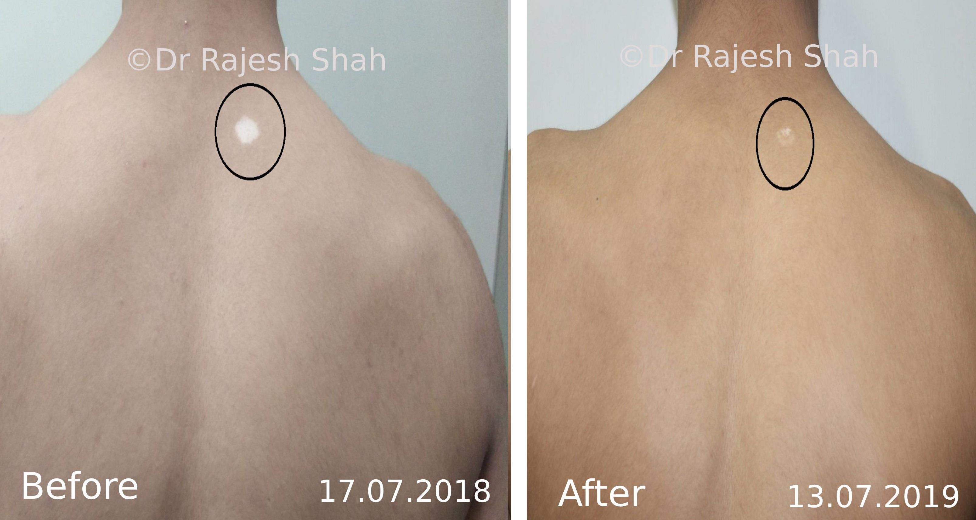 Vitiligo Before and After Case Photo