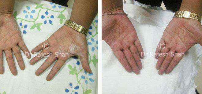 Psoriasis Before and After Case Photo