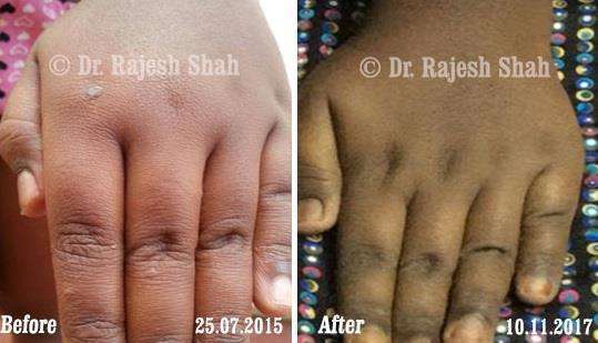 Lichen Planus Before and After Case Photo