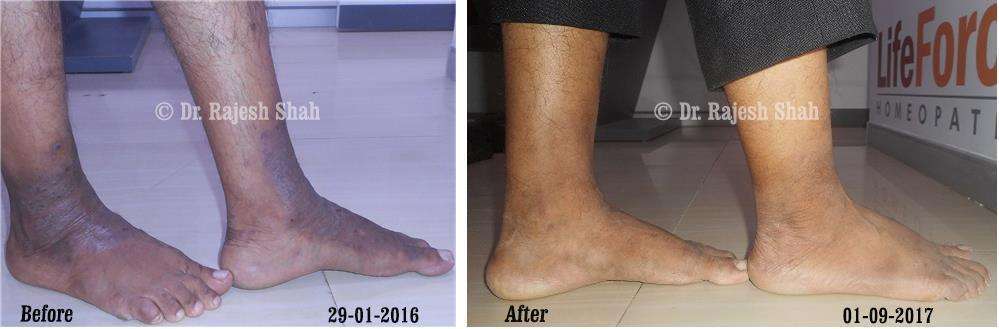 Eczema Before and After Case Photo