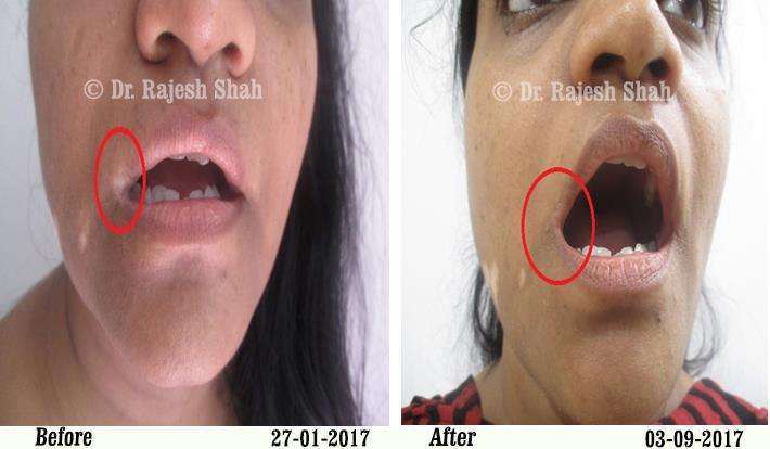 Vitiligo Before and After Case Photo