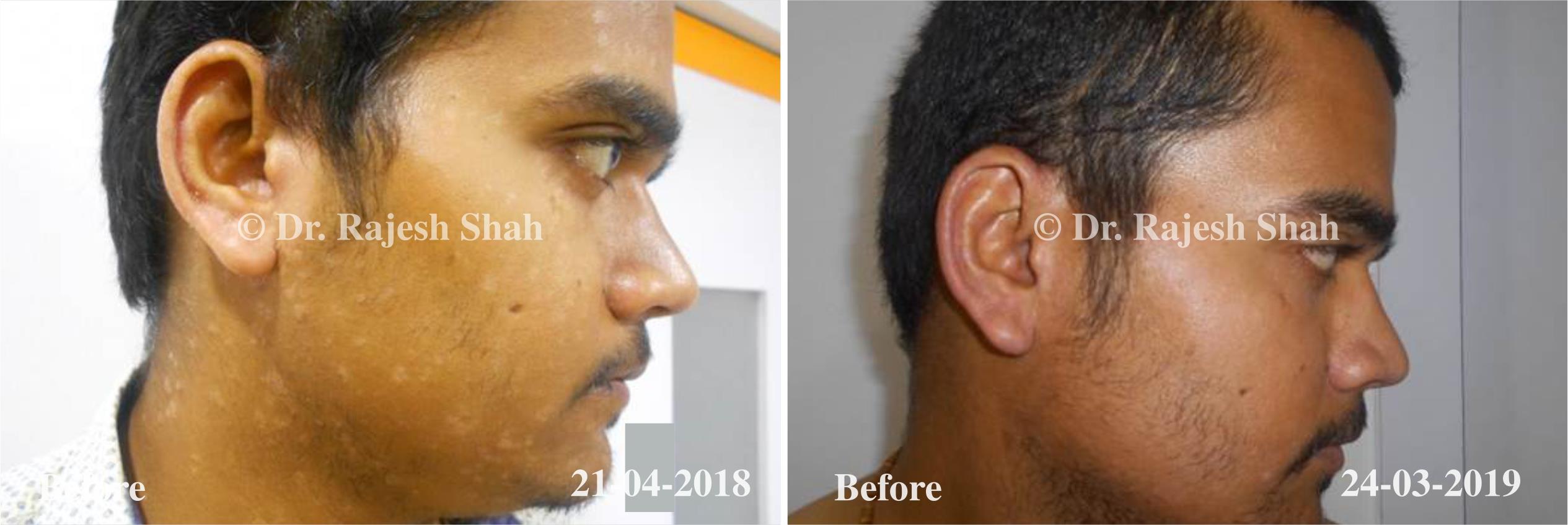 Psoriasis Before and After Case Photo