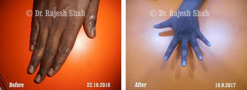 Psoriasis Before and After Case Photo