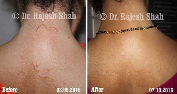 Granuloma Annulare Before and After Case Photo